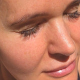 Skin Peel After Image