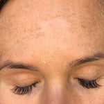 Skin Peel Day 5 Image