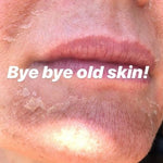 Skin Peel Day 3 Image